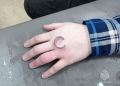 МЧС спасает пальцы колымчан от неснимаемых колец